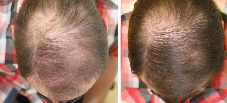 Is there a hair loss quick fix?