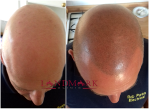 Rob - before and after hair transplant surgery