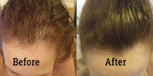 Hair loss in women